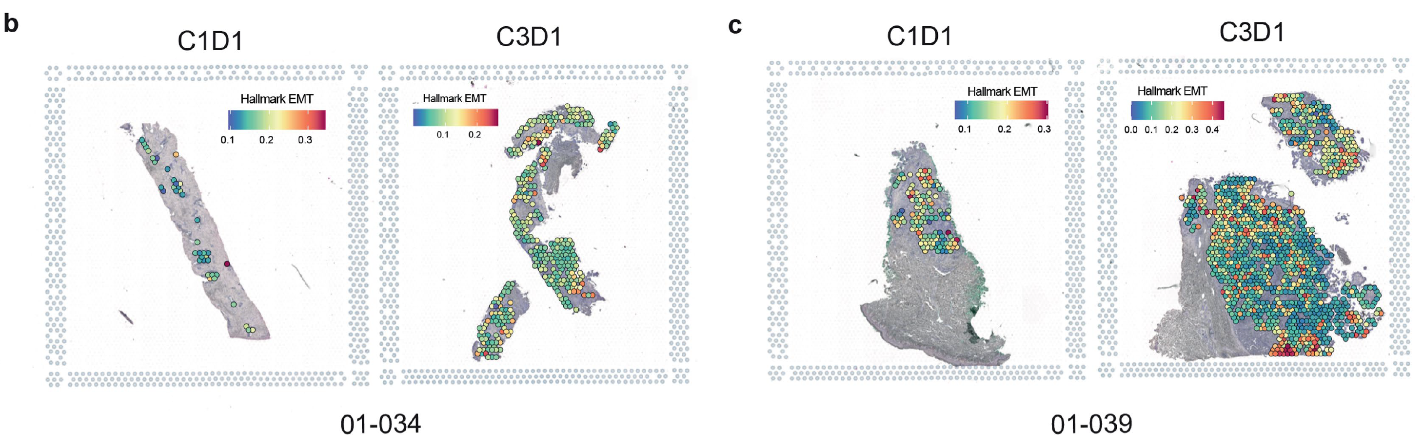 Extended Data Figure 3b,c from Cassier et al. showing Visium Spatial data on paired pre- and post-treatment samples from two patients (01-034 and 01-039). EMT score enrichment is indicated on Visium tumoral spots. Credit: Cassier P, et al. Nature 620: 409–416 (2023). doi: 10.1038/s41586-023-06367-z (CC BY 4.0).