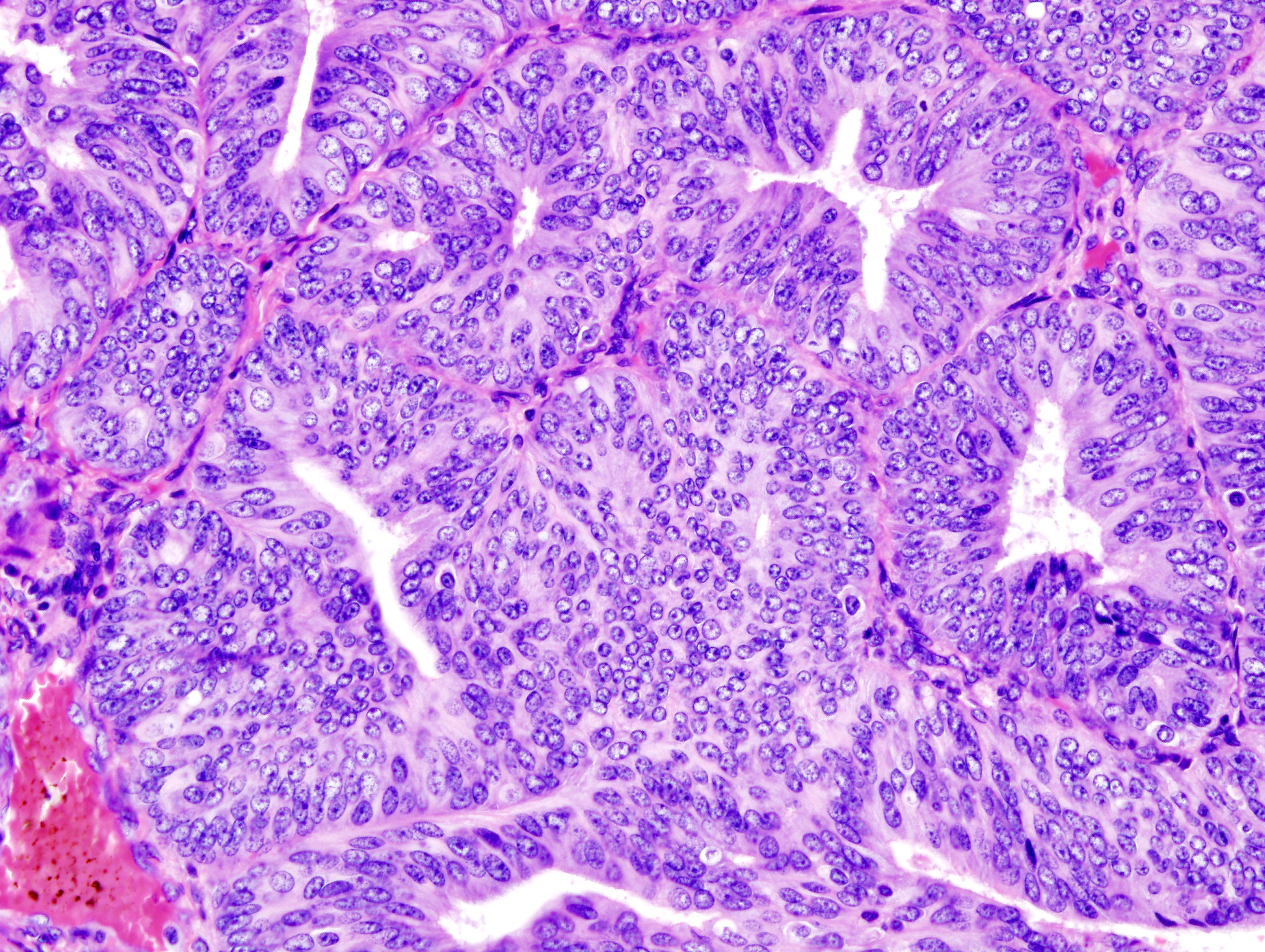 Histopathologic representation of endometrioid adenocarcinoma demonstrated in endometrial biopsy. Hematoxylin-eosin stain. Credit: KGH (CC BY-SA 3.0).  