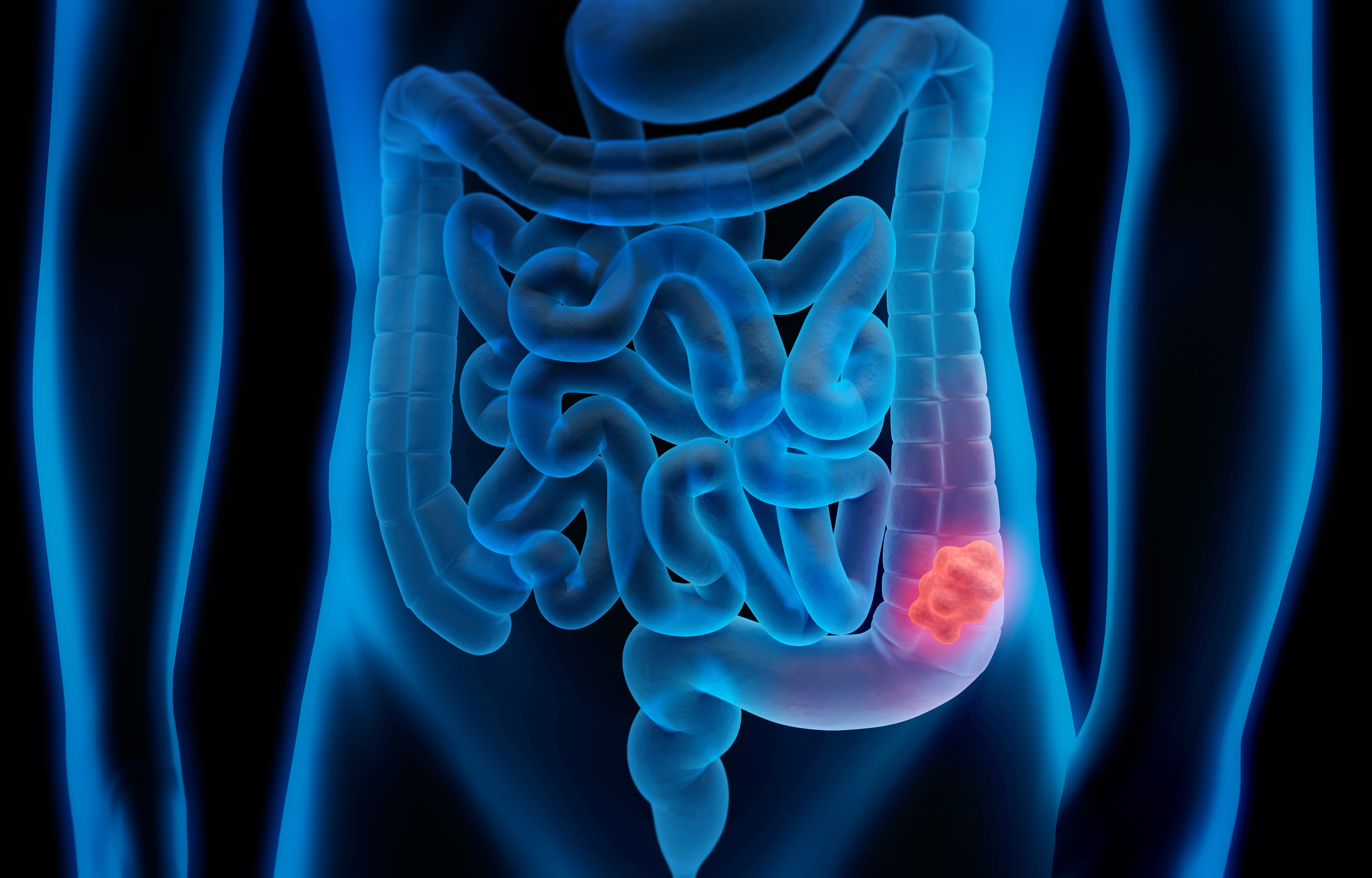 Diagram of colorectal cancer. Credit: Getty Images.