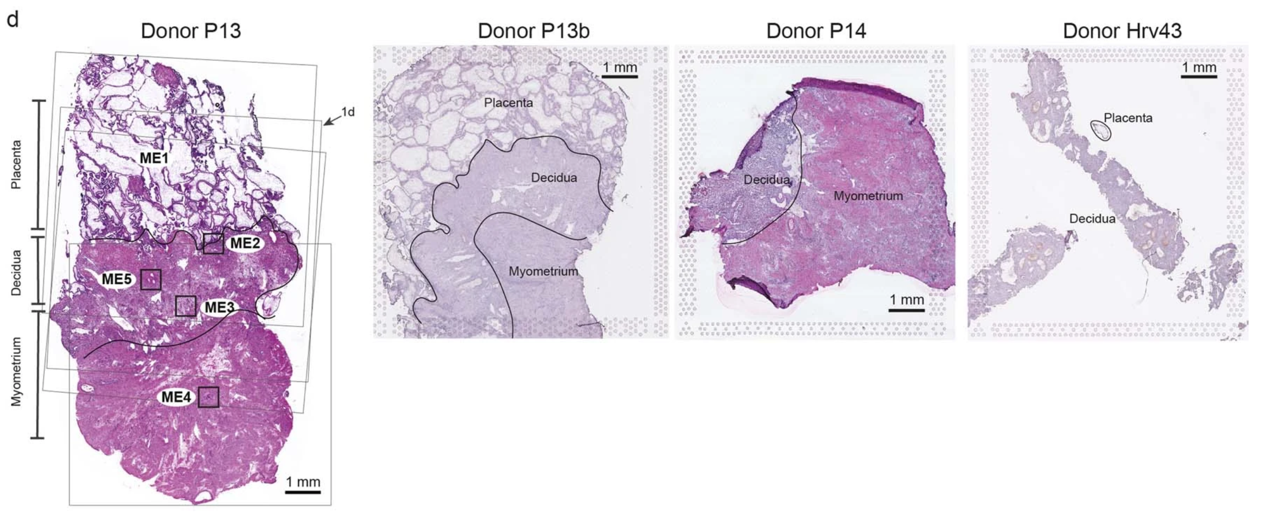Extended Figure 1d from Arutyunyan et al. Histological overview (H&E staining) of donors P13, P14, and Hrv43 tissues with annotations of tissue regions. For the implantation site of donor P13 (~8–9 PCW, left), black squares (small) indicate trophoblast microenvironments in space; faint grey squares (large) indicate positioning of tissue on Visium spatial transcriptomics Capture Areas; arrow indicates representative Visium section further explored in Fig. 1d. For Visium, P13 (n = 5 feature areas, 4 consecutive slides with overlapping positions and 1 slide from an additional tissue block—P13b), P14 (n = 2 feature areas, consecutive slides with same position), Hrv43 (n = 1 feature area). Credit: Arutyunyan A, et al. Spatial multiomics map of trophoblast development in early pregnancy. Nature 616: 143–151 (2023). doi: 10.1038/s41586-023-05869-0. (CC BY 4.0).