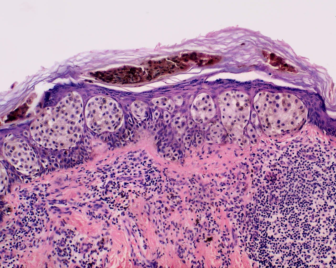 Melanoma in skin biopsy with H&E stain. Credit: Wozniak L & Zielinski KW. Own work (CC BY-SA 3.0).
