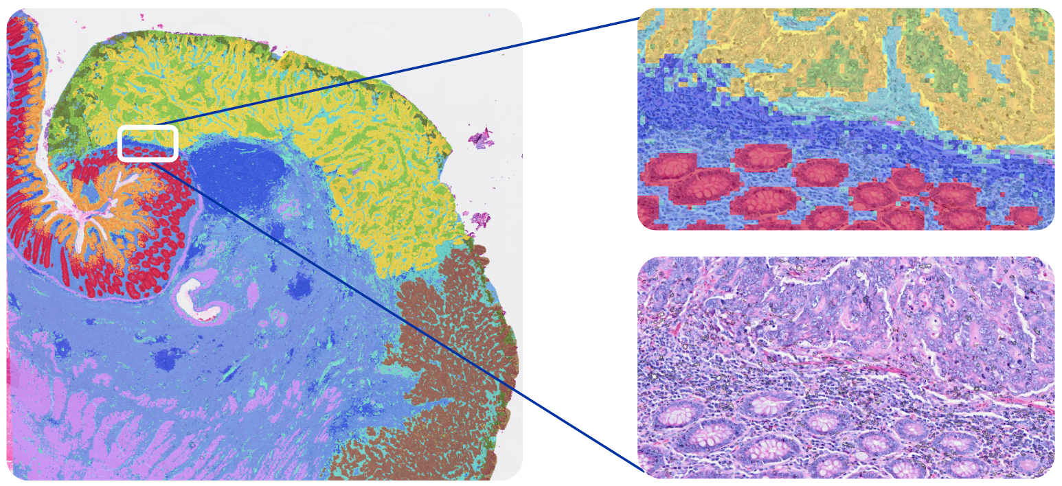 Figure 1B. Visium HD analysis of human colon cancer tissue stained with H&E and transcripts assigned to 8 x 8 µm bins. A zoomed-out picture of human colon cancer with unsupervised gene expression clustering (left panel) and zoomed-in samples of clustered gene expression (top right) in 8 x 8 µm bins as well as H&E-stained tissue (bottom right). Visium HD allows resolution of transcripts down to 2 x 2 µm squares, but the recommended starting bin size for visualization and analysis is 8 x 8 µm.
