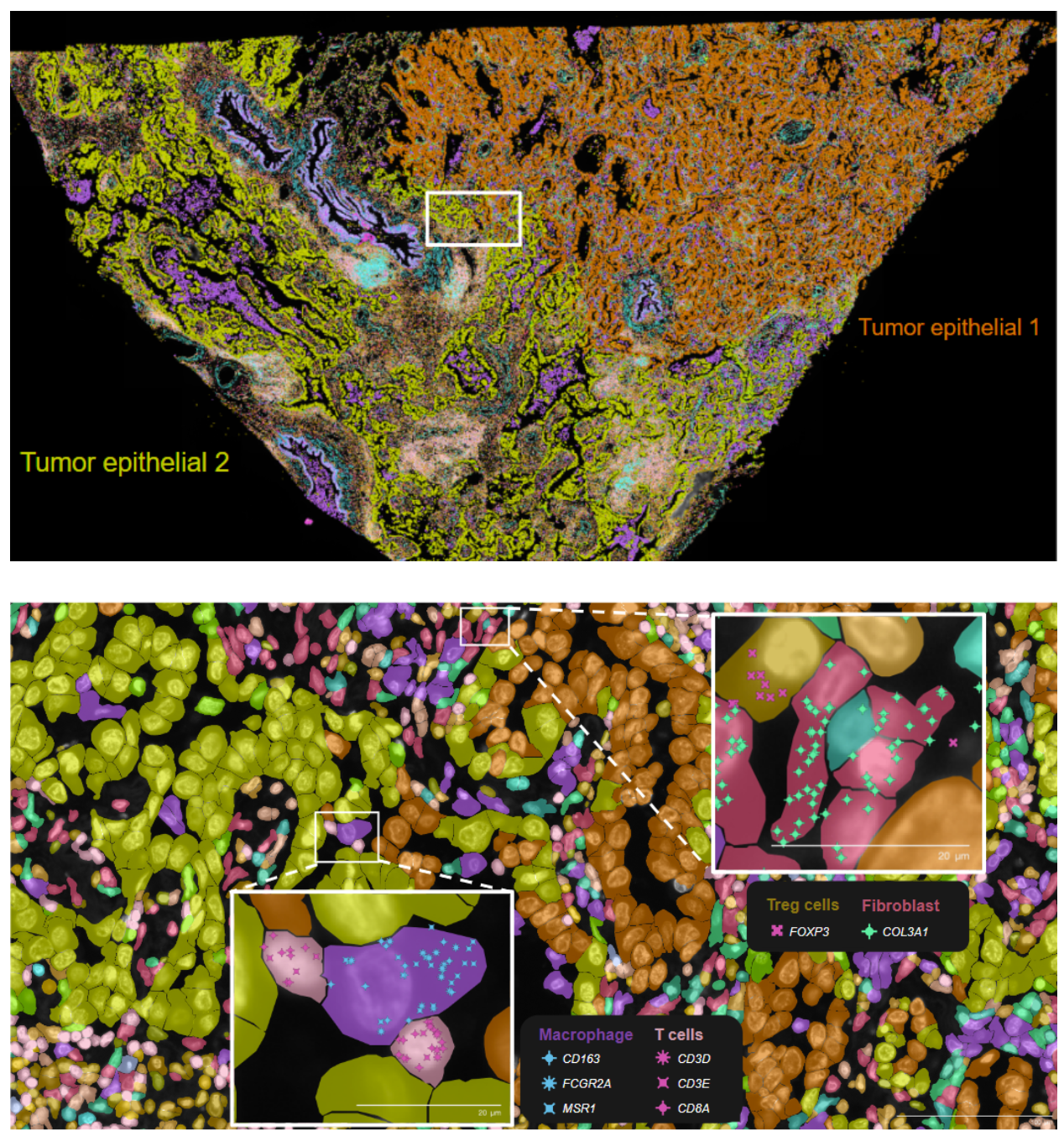 Figure 2. Xenium Explorer analysis of human lung adenocarcinoma. An image of a section of human lung adenocarcinoma is shown in the top panel, with Xenium Explorer zoomed in (bottom panel) to segmented cells and selected transcripts associated with immune cell types localized within individual cells.