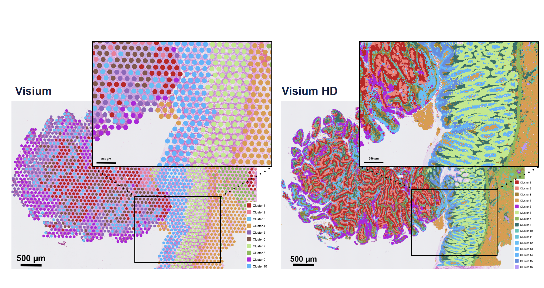 Figure 4. A side-by-side comparison of Visium v2 data (left) and Visium HD data (right) in FFPE human colorectal cancer, demonstrating the enhanced discovery power of whole transcriptome spatial gene expression at single cell–scale resolution.