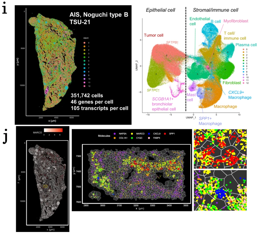 Figure 2. Single cell spatial analysis of case TSU-21 using Xenium In Situ. (i) Spatial distribution (left) and UMAP (right) of cell clusters identified by Xenium. (j) Xenium spatial expression pattern of an alveolar macrophage marker MARCO (left). Patterns of several macrophage markers in local regions (middle and right). Each dot represents a detected RNA molecule. Image adapted from Figure 6 from Haga et al. 2023. (CC BY 4.0).