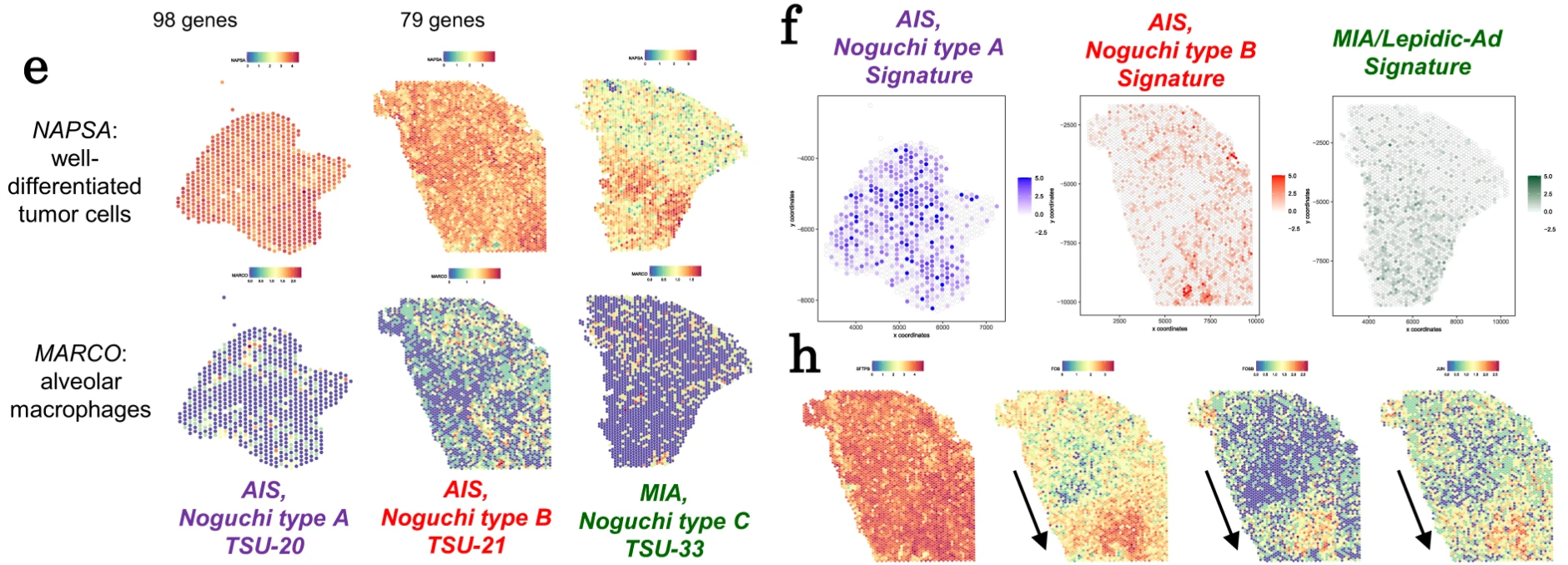 Figure 1. (e) Visium spatial transcriptomic analysis for three representative cases (TSU-20, TSU-21, and TSU-33). Expression patterns of marker genes for well-differentiated tumor cells (NAPSA) and alveolar macrophages (MARCO) are represented. (f) Enrichment scores of transcriptome signature genes in the corresponding histological types in Visium data. (h) Spatial expression patterns of tumor cell markers in Visium data. Image adapted from Figure 6 from Haga et al. 2023. (CC BY 4.0).