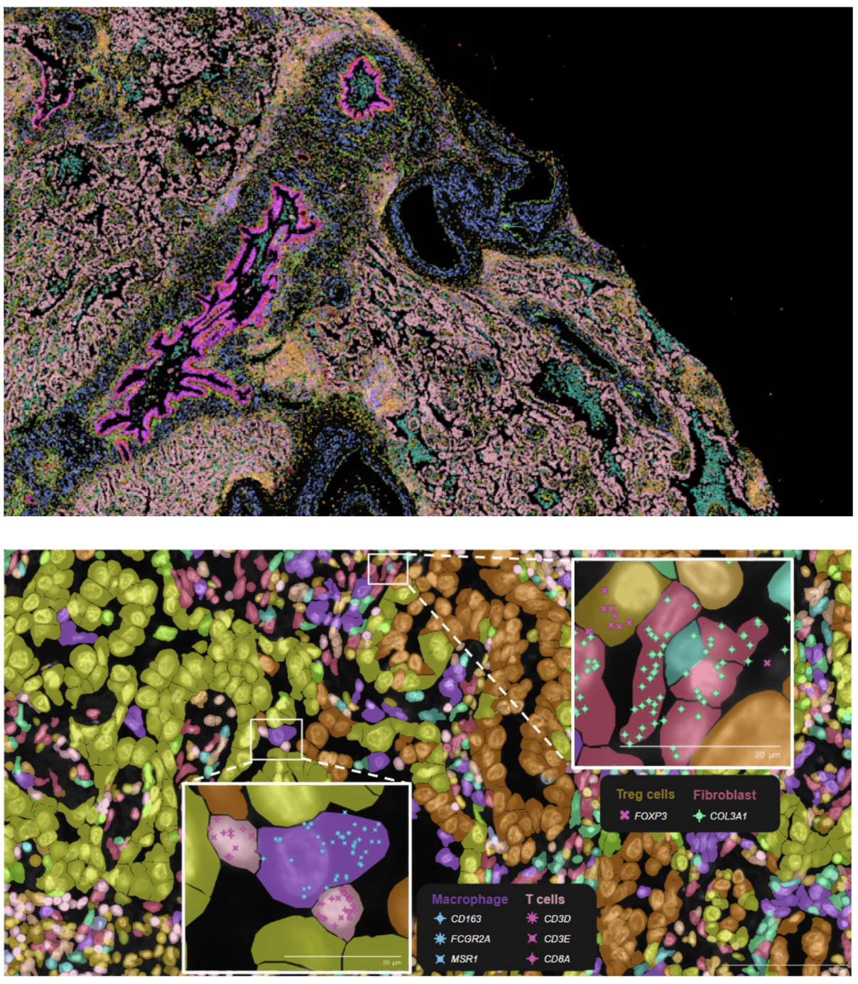 Figure 3. Xenium Explorer analysis of human lung cancer. An image of an FFPE section of human lung adenocarcinoma is shown in the top panel, with Xenium Explorer zoomed in (bottom panel) to segmented cells and selected transcripts associated with immune cell types localized within individual cells.