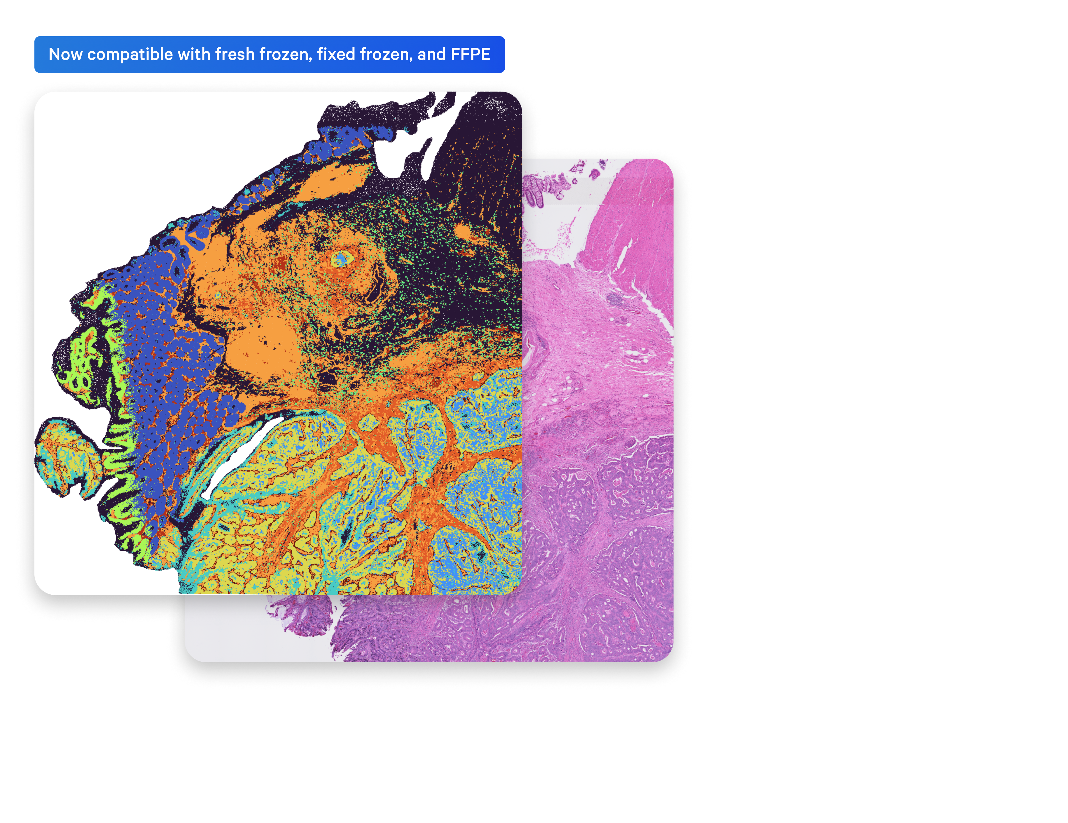 Overlay of Visium HD data and H&E image from the same tissue section