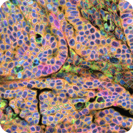 FFPE Human Ovarian Cancer with 5K Human Pan Tissue and Pathways Panel plus 100 Custom Genes