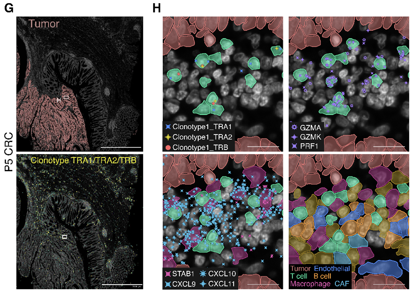 Figure 3. Xenium in situ confirms the existence and localization of macrophage subtypes and clonally expanded T cells in the tumor microenvironment. G. Combined expression of clonotype TRA1/TRA2/TRB in sample P5 CRC. H. Clonally expanded CD8 cytotoxic T cells reside closely to tumor cells and within CXCL9/CXCL10/CXCL11 foci. Credit: Figure 7G,H from Oliveira MF, et al. (1). CC BY-ND 4.0.