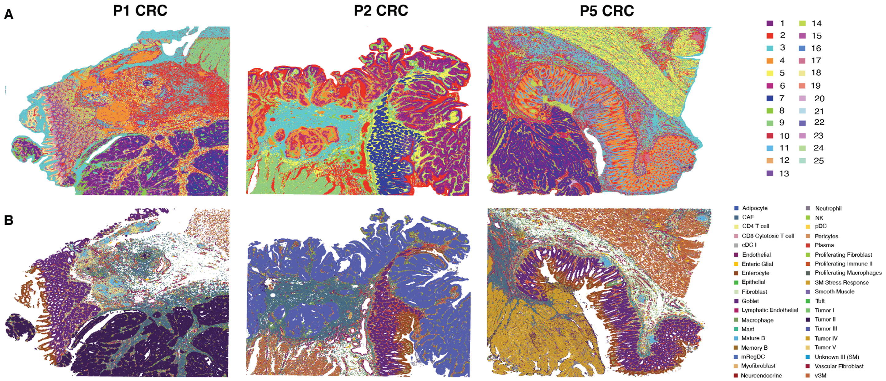 Figure 1. Spatial mapping of colorectal cancer (CRC) samples using Visium HD reveals high-resolution and accurate transcript mapping. A. Spatial mapping of three CRC samples (P1 CRC, P2 CRC, and P5 CRC) with 8-µm bins colored based on unsupervised clustering. B. Spatial mapping of the same three CRC samples with 8-µm bins colored by cell types predicted by deconvolution using the single cell reference dataset. Credit: Figure 3A,B from Oliveira MF, et al. (1). CC BY-ND 4.0. 