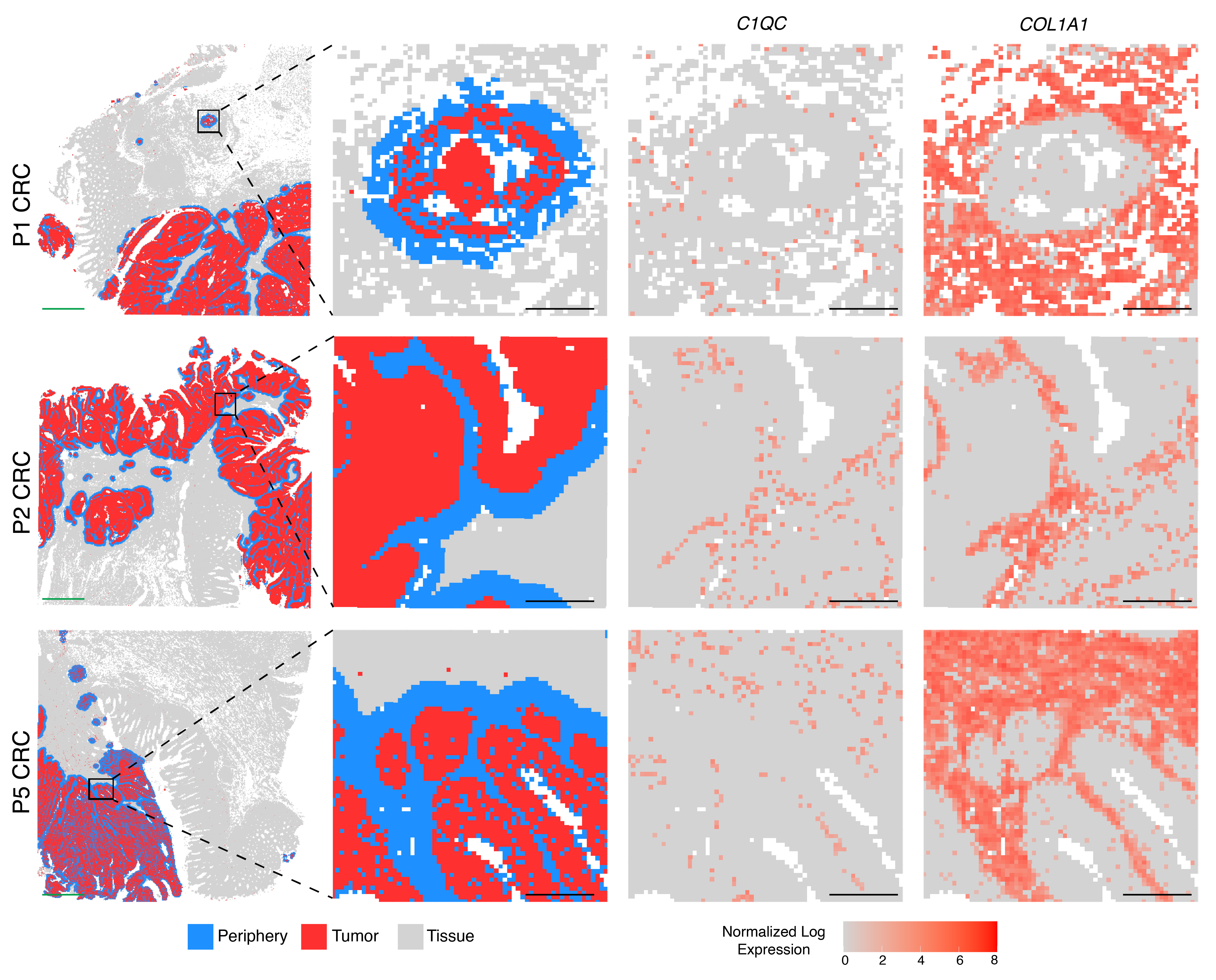 Figure 2. Cellular composition of the tumor periphery in each CRC section. 8-μm bins annotated as tumor cells are shown in red and bins within 50 µm of the tumor periphery shown in blue. Rows correspond to three different samples. The first column shows the 6.5 x 6.5 mm capture area, the second column shows the zoomed-in view, the third column shows the corresponding expression of C1QC (macrophages), and the fourth column shows the corresponding expression of COL1A1 (fibroblasts). Credit: Figure 4A from Oliveira MF, et al. (1). CC BY-ND 4.0. 