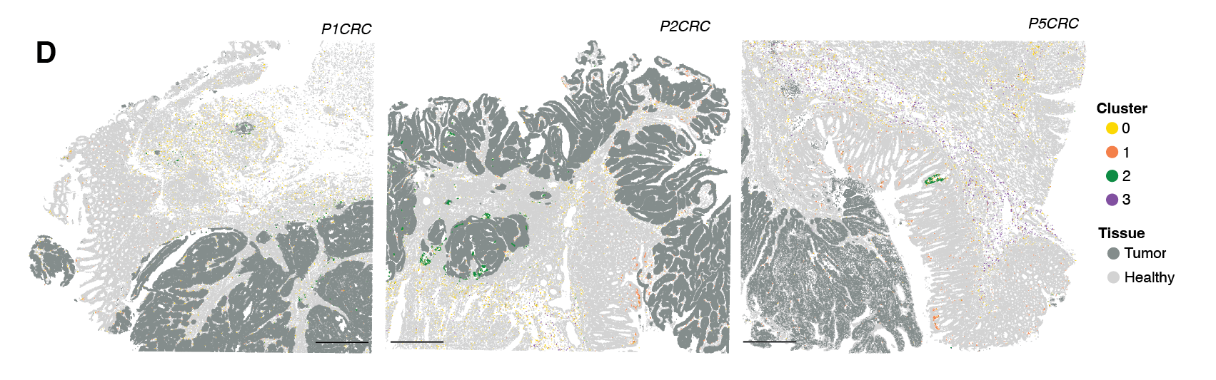 Figure 4. Localization of four macrophage subpopulations across P1CRC, P2CRC, and P5CRC patient tumor samples. Credit: Extended Data Figure 7D from Oliveira MF, et al. (1). CC BY-ND 4.0.