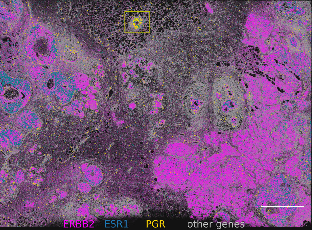 Transcript view of ERBB2, ESR1, PGR and the rest of gene