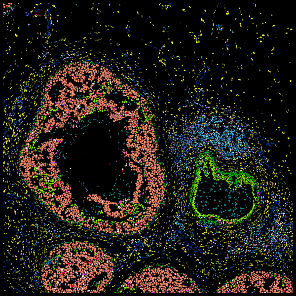 DCIS (left) in proximity to benign duct ectasia (right)