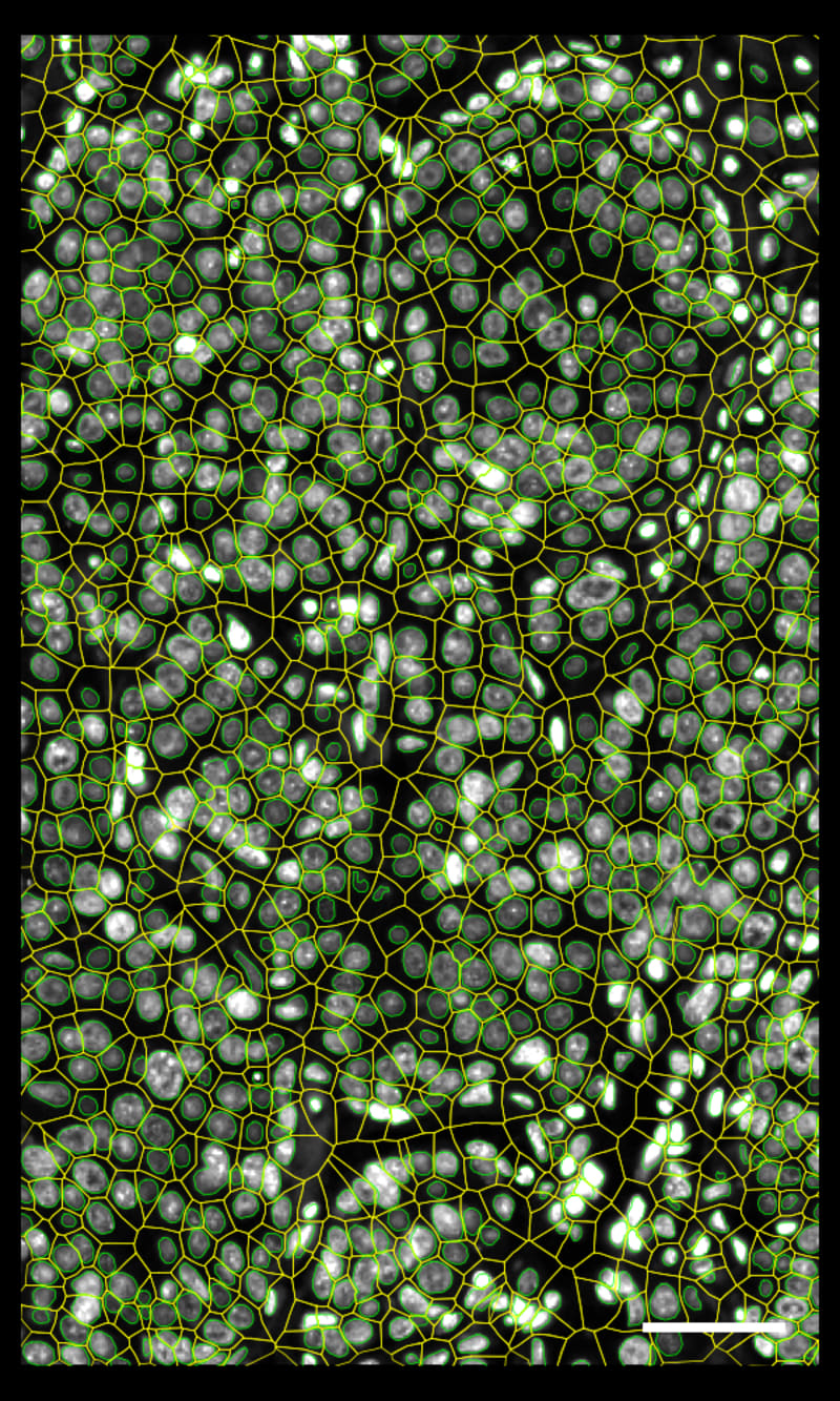 ヒト乳腺腫瘍の探索 - 10x Genomics