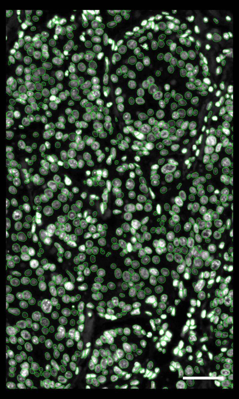 Human Breast Dataset Explorer - 10x Genomics Human Breast Dataset Explorer - 10x Genomics